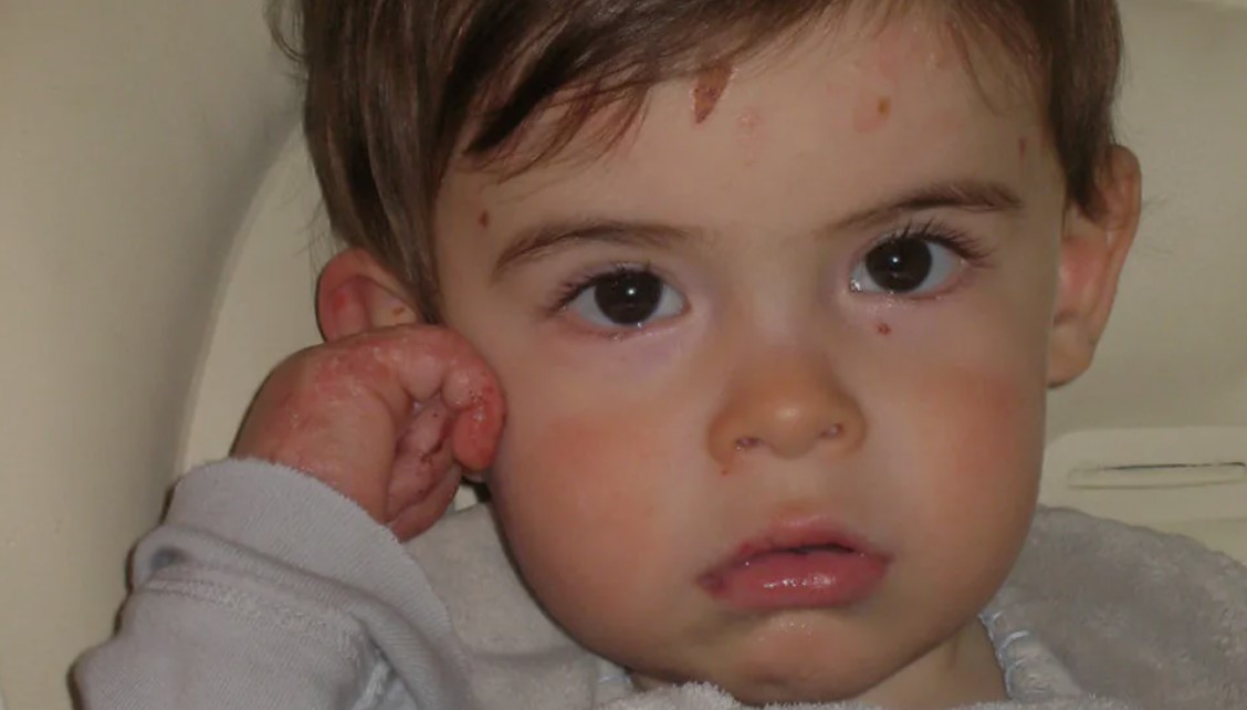 FDA Grant Boosts Exton-Based Castle Creek Biosciences’ Effort to Treat ‘Butterfly Children’